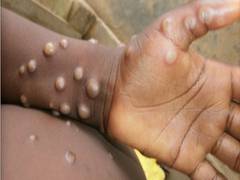 
      
      Centre to release guidelines on Monkeypox
      
      