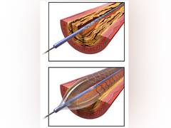 
      
      Pollution and winter linked with higher rate of angioplasty...
      
      