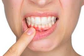 
      
      Plant-based diet effective in reducing gingivitis
      
      