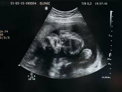 
    Human fetuses evolved to slow shoulder growth, says study
    