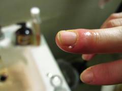 
      
      Rapid detection of infection in wounds done using low-cost...
      
      