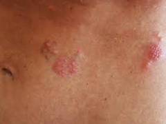 
      
      Chickenpox vaccination can protect against shingles, finds study
      
      