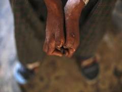 
      
      Japan's Nippon Foundation helps in tackling Hansen's disease...
      
      