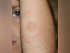 
      
      New effective vaccines required to prevent Lyme disease: study
      
      