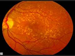 
      
      Age-related macular degeneration likely to cause central...
      
      