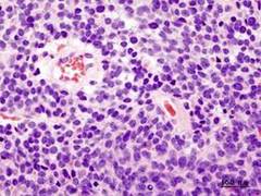
      
      Study identifies novel potential combination therapy for...
      
      