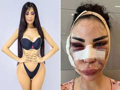 
      
      Woman spent $600K to be Kim K; $120K to detransition
      
      