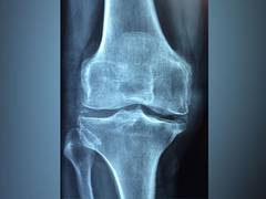 
      
      Researchers develop new approach to treating osteoarthritis
      
      