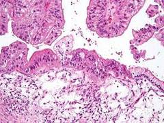 
      
      Test measures immune response to improve ovarian cancer...
      
      