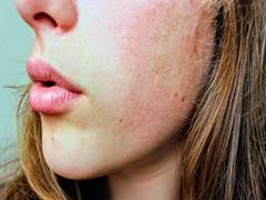
      
      Research finds mites live on skin of face and mate at night
      
      
