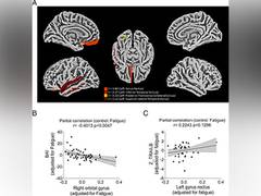 
      
      Study describes how COVID-19 damages the brain
      
      