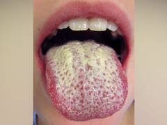 
      
      Starving fungus can help beat drug-resistant fungal infection 
      
      