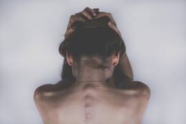 
      
      Body mass index plays significant role in progression of...
      
      