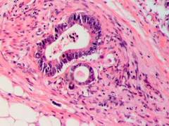 
      
      Researchers identify key protein that supports growth of many...
      
      