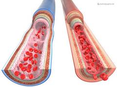 
      
      Critically blocked leg arteries cause veterans' death: Study  
      
      