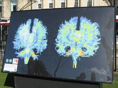 
      
      Researchers using MRI reveals brain damage in obese teens
      
      