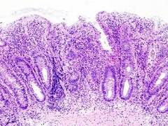
      
      Bowel cancer is increasing among younger adults in England: Study 
      
      
