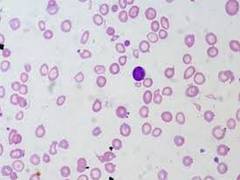 
      
      Study reveals improved treatment for children with sickle...
      
      