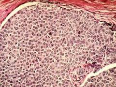 
      
      Study reveals protein that helps trap bacteria may contribute...
      
      