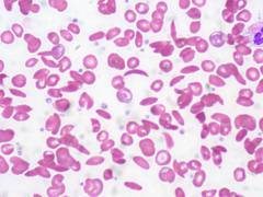 
      
      All you need to know about sickle-cell disease
      
      