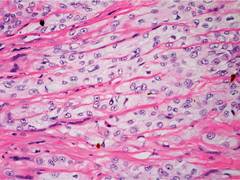 
      
      Researchers identify new genomic regions that increase risk...
      
      