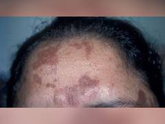
    People with benign skin condition willing to give time, money to cure the condition 
    