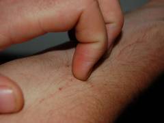 
      
      Study reveals wildfire smoke linked to skin disease
      
      