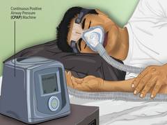 
      
      Tongue fat loss improves sleep apnoea, finds Study
      
      