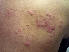 
      
      Researchers discover vaccine to treat herpes
      
      
