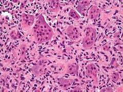 
      
      Study highlights proteins involved in tumour growth and metastasis
      
      