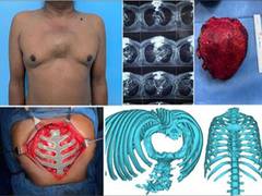 
      
      Technological advancement of 3D printing: Malignant Sternal...
      
      