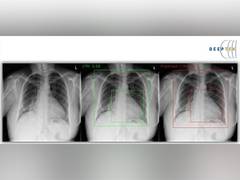 
      
      Enlarged Heart, Pulmonary Edema and Fluid in the Pleural Space 
      
      