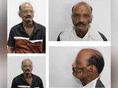 
      
      Specialized Silicone Prosthesis Procedure at SRM...
      
      