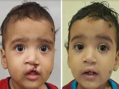 
      
      Saveetha join hands with Smile Train for cleft care
      
      