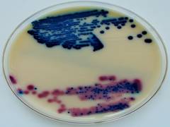 
      
      Accurate tests required to cure urinary tract infections: Study
      
      