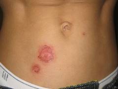 
      
      Study finds breakthrough in understanding rare genetic skin...
      
      