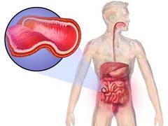 
      
      New AI method may improve Crohn's disease treatment
      
      