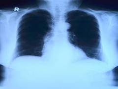 
      
      AI tool uses chest X-ray to differentiate worst cases of...
      
      