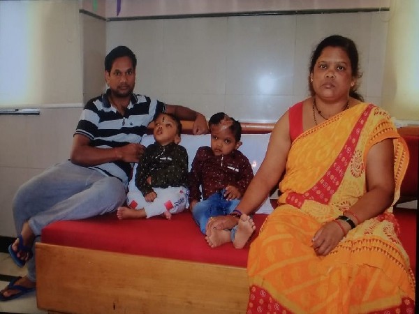 Craniopagus twins Jagga, Baliya in New Delhi. (File photo)