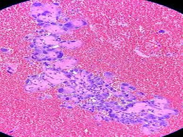 Mohs surgery has a nearly 99 per cent cure rate for early melanoma and results in minimal scarring.