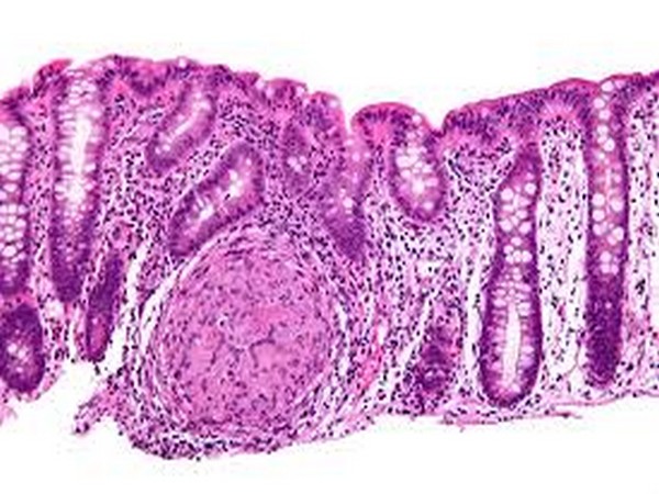 The genetic mutation shares a link with the JAK2 pathway, an important target of multiple immunotherapies.