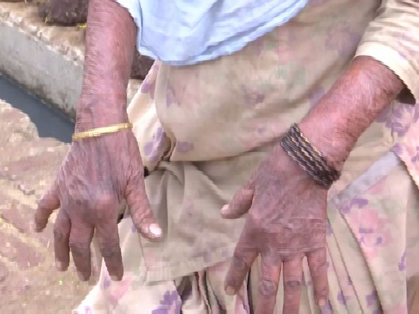 A woman of Kanakwal village in Bathinda district shows her hands allegedly affected by Sulphur gas. Photo/ANI