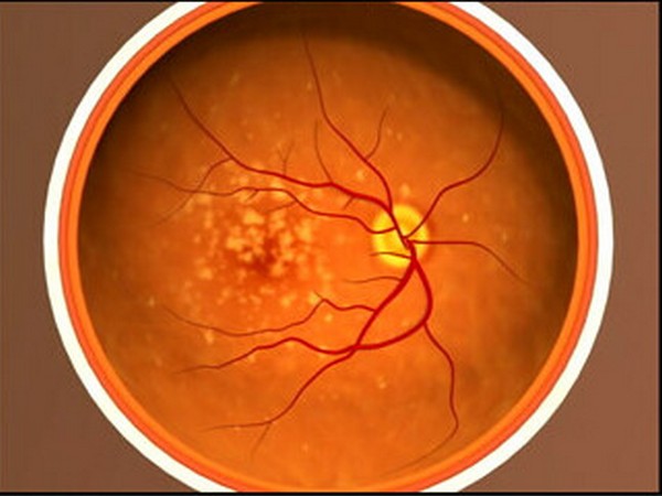 High consumption of vegetables rich in carotenoids and fatty fish containing Omega-3 fatty acids was beneficial for those at the risk of AMD.