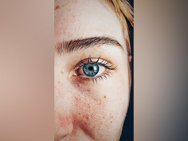 Representative image