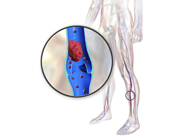 Thrombosis is a condition which forms blood clots in blood vessels, artery or vein, making a person prone to heart attack, stroke, or a life-threatening clot in the lungs.