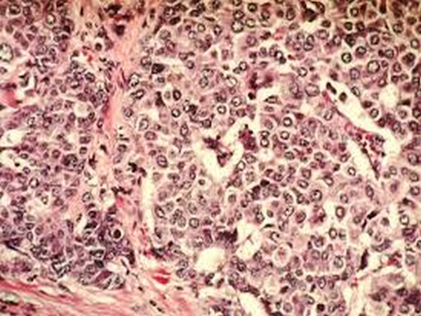 Breast Cancer cells.