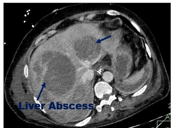 A liver abscess (Pus formation in the Liver) is commonly caused by a parasite known as Entamoeba histolytica which is transmitted by contaminated food and water.