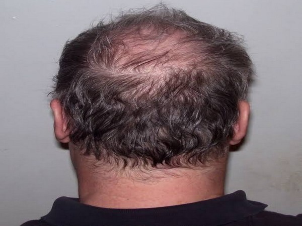 The technique, which is described in 'Scientific Reports' is based on the finding that when the scalp is lightly pressed on a region containing healthy hair follicles.