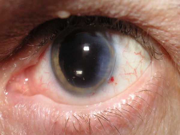 Cataract surgery replaces the cloudy lens with an artificial lens