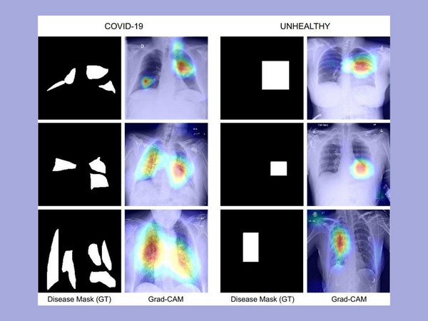 X-Ray images of lungs from the research. (ANI/photo)